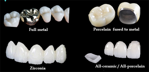 不同材质的烤瓷牙冠