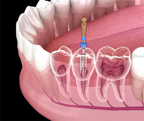根管治疗修复坏牙