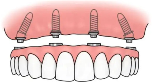半固定种植牙卡通图