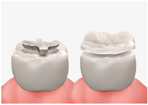 补牙动画图示 补牙动画图示