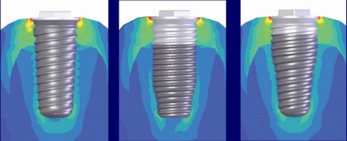 不同尺寸的植体照片 不同尺寸的植体照片