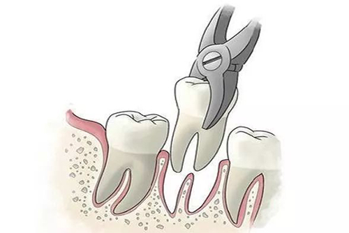 拔牙示意图