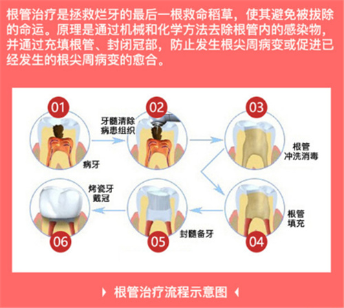 根管治疗流程展示