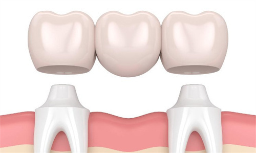 牙冠三联桥