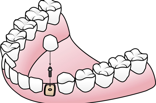 种植牙安装牙冠卡通图