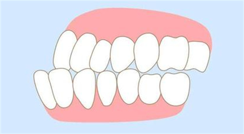 牙齿错颌畸形照片