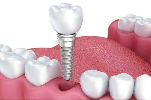 种植牙植入图 种植牙植入图