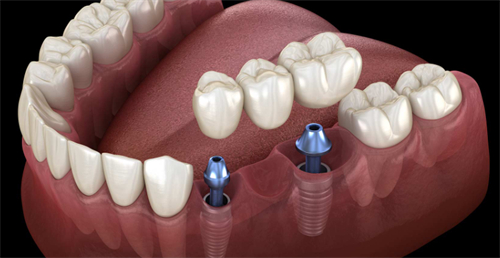 连冠的种植牙 连冠的种植牙