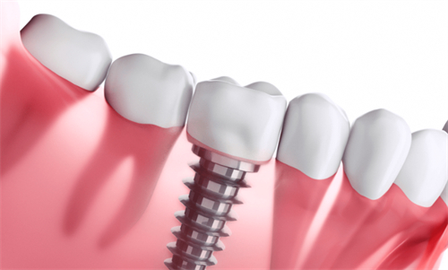 种植牙种植后的样子 种植牙种植后的样子