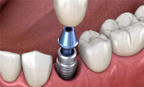种植牙卡通图 种植牙卡通图
