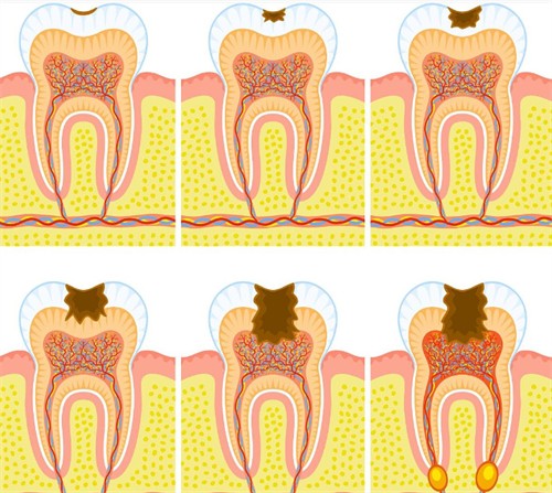 牙齿逐步变蛀牙过程