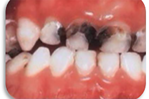 牙根龋坏图片 牙根龋坏图片