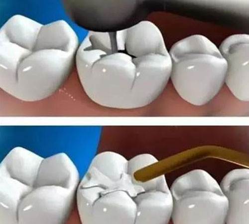 补牙过程示意图 补牙过程示意图