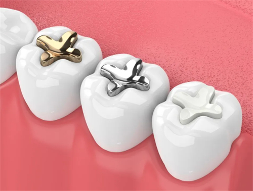 不同材质的补牙材料 不同材质的补牙材料