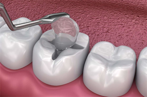 对坏牙进行填补 对坏牙进行填补