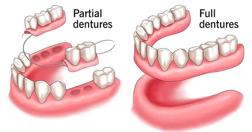 佩戴活动假牙 佩戴活动假牙