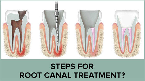 根管治疗手术过程 根管治疗手术过程