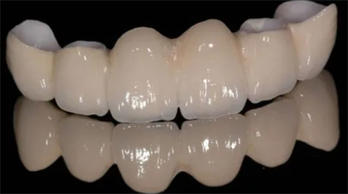 烤瓷牙的颜色和光泽 烤瓷牙的颜色和光泽