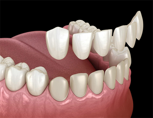 牙齿贴面改善牙齿颜色和形状 牙齿贴面改善牙齿颜色和形状
