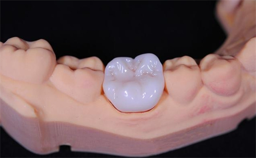 全瓷牙冠 全瓷牙冠