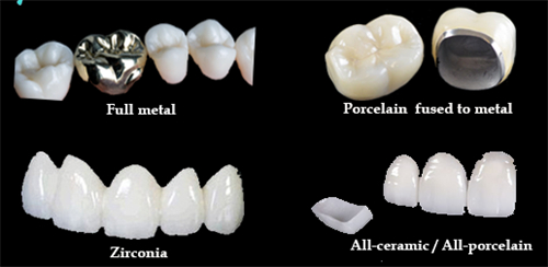 不同材质的烤瓷牙冠 不同材质的烤瓷牙冠