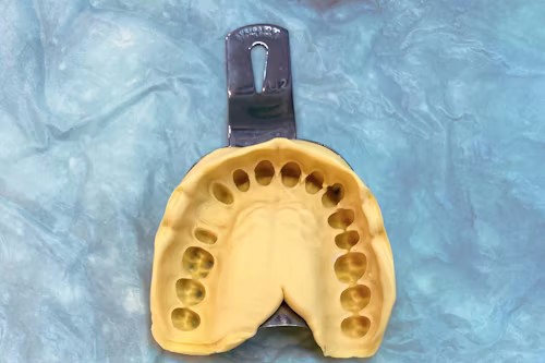 牙冠制作 牙冠制作