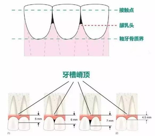 牙齿龈嵴顶图示