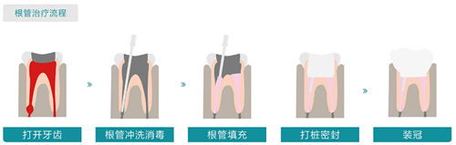 根管治疗流程图展示