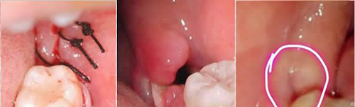 拔智齿缝合示意图