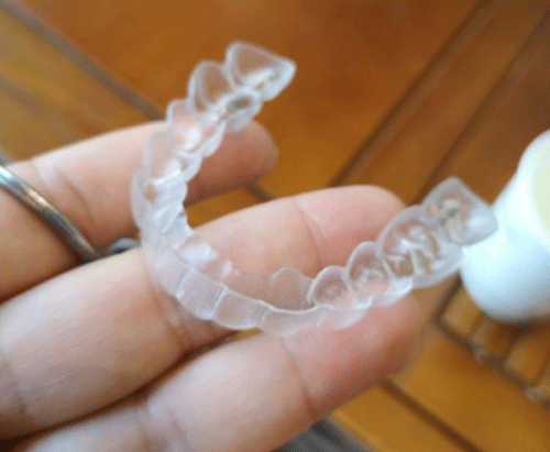 隐形牙齿矫正牙套图.jpg