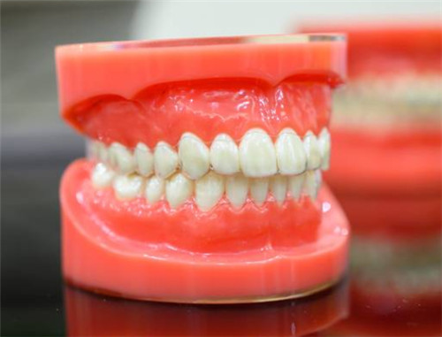 隐形矫正牙套佩戴模型展示图.jpg