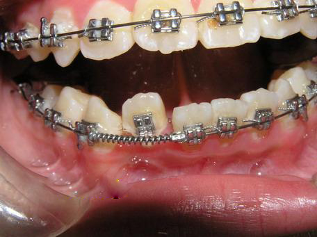 牙齿矫正正畸推簧口内展示图.jpg
