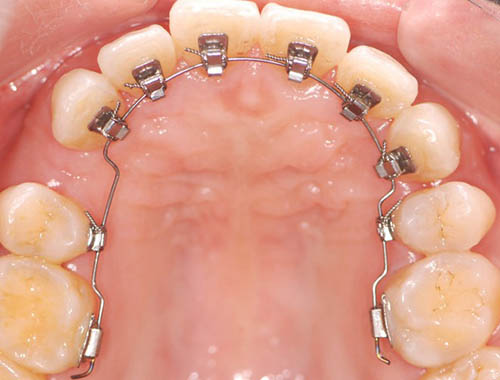 舌侧矫正细节图.jpg 舌侧矫正细节图.jpg