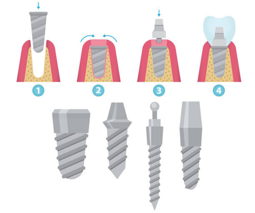 种植牙步骤和植体型号.jpg 种植牙步骤和植体型号.jpg