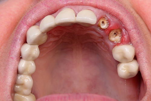 牙齿龋坏钻洞实拍