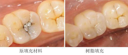 补牙材料不同示意图.jpg