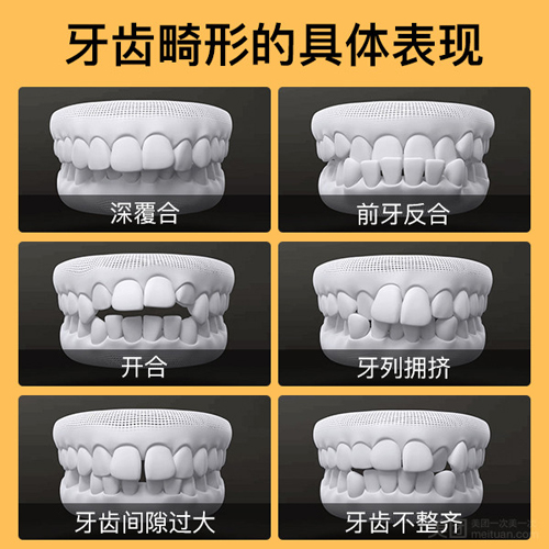 牙齿畸形形式