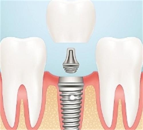 种植牙的组成部分 种植牙的组成部分
