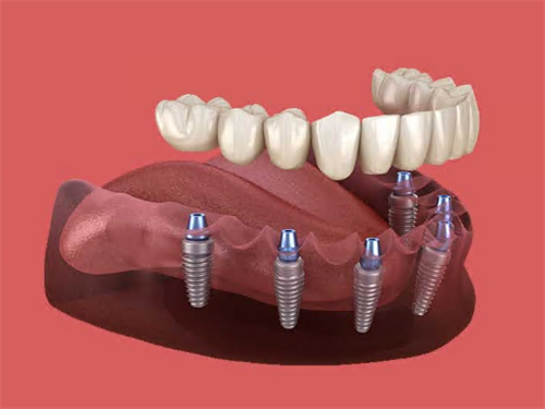 半口种植牙动画示意图展示 半口种植牙动画示意图展示