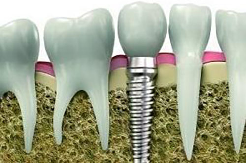 种植牙和真牙牙根对比示意图 种植牙和真牙牙根对比示意图