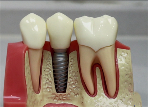 种植牙模型实物展示图 种植牙模型实物展示图