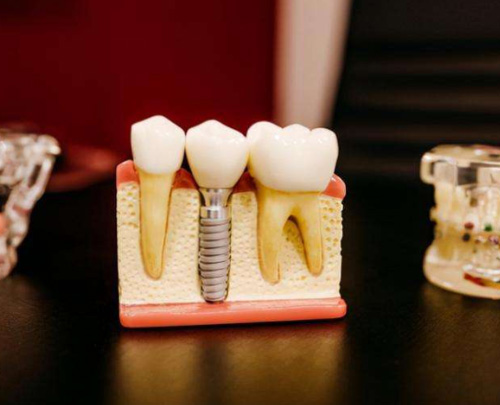 种植牙模具图 种植牙模具图