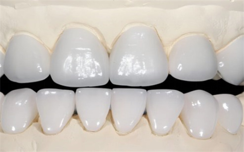 全口全瓷牙 全口全瓷牙