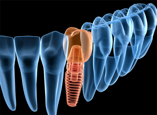 单颗种植牙演示图 单颗种植牙演示图