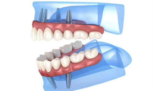 全口种植模拟图 全口种植模拟图