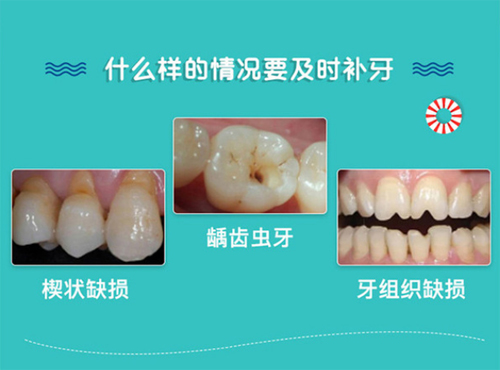 补牙适应症 补牙适应症