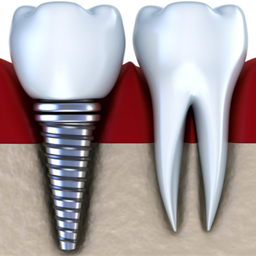 单颗种植牙展示图 单颗种植牙展示图