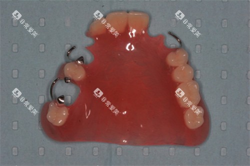 半口可摘局部义齿展示图