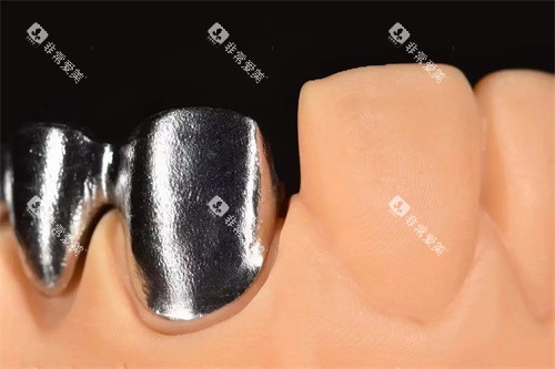 义佳微纳熔覆义齿实物图