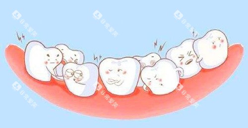 牙齿拥挤动画